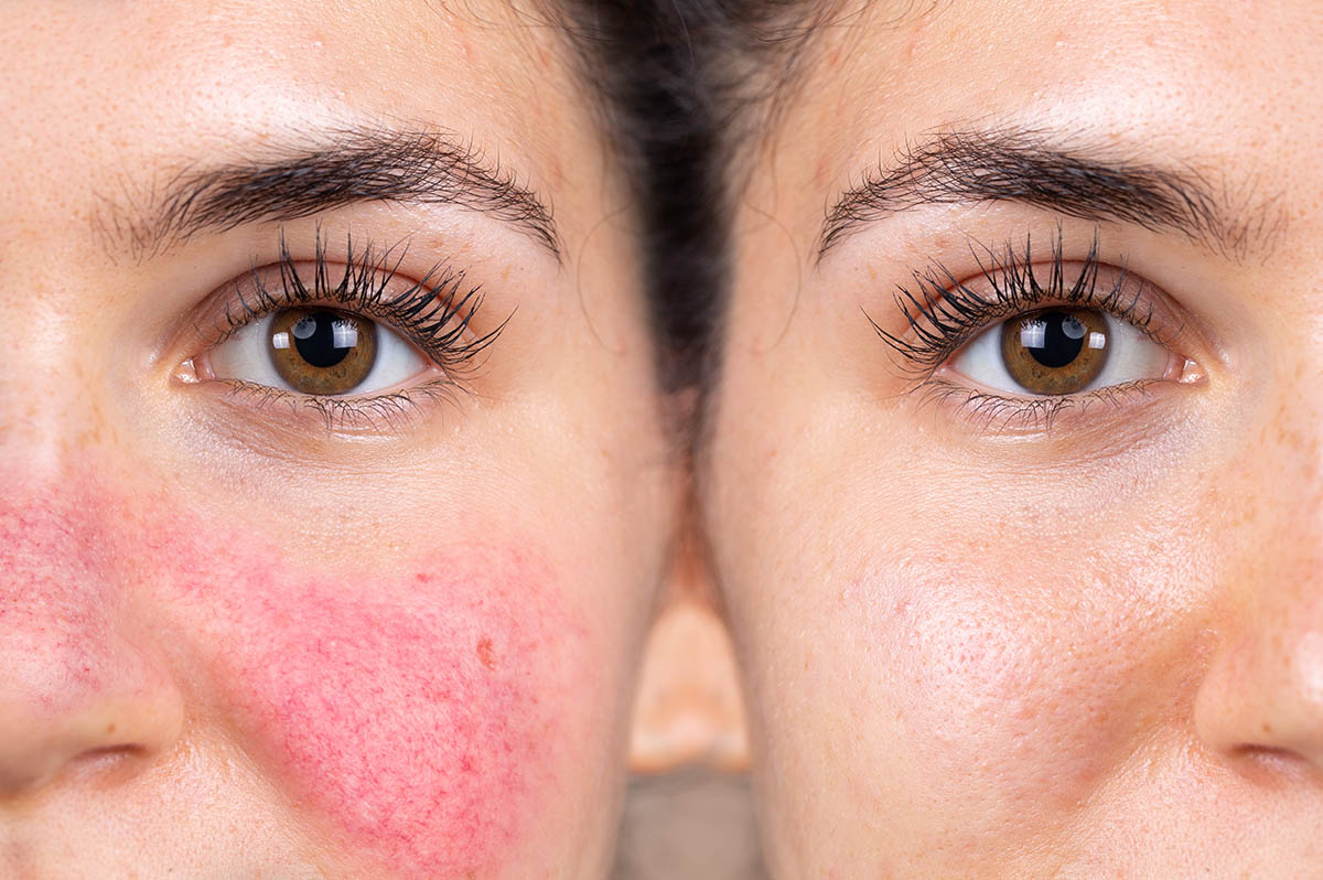 Cómo elegir la mascarilla facial adecuada: de los beneficios al tiempo de  aplicación para lucir un rostro perfecto