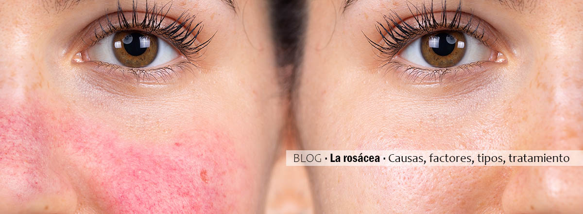 rosacea