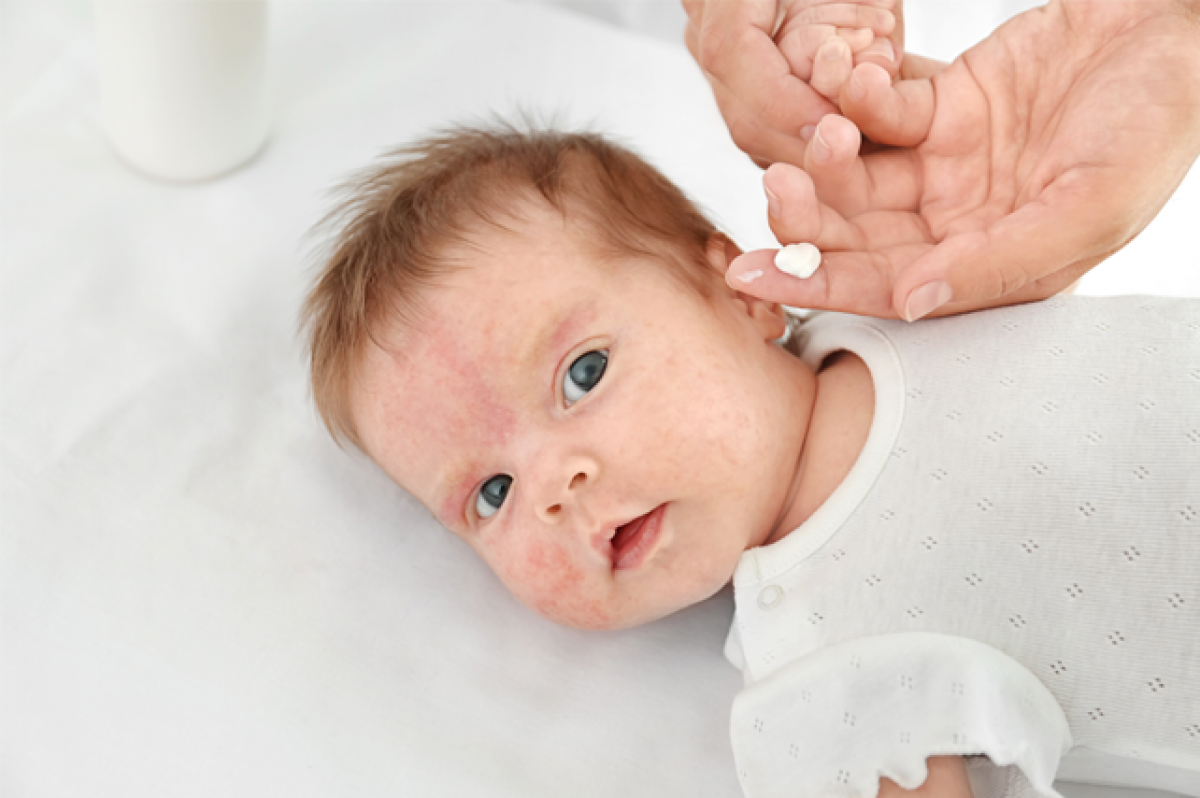 Dermatitis atópica en el bebé