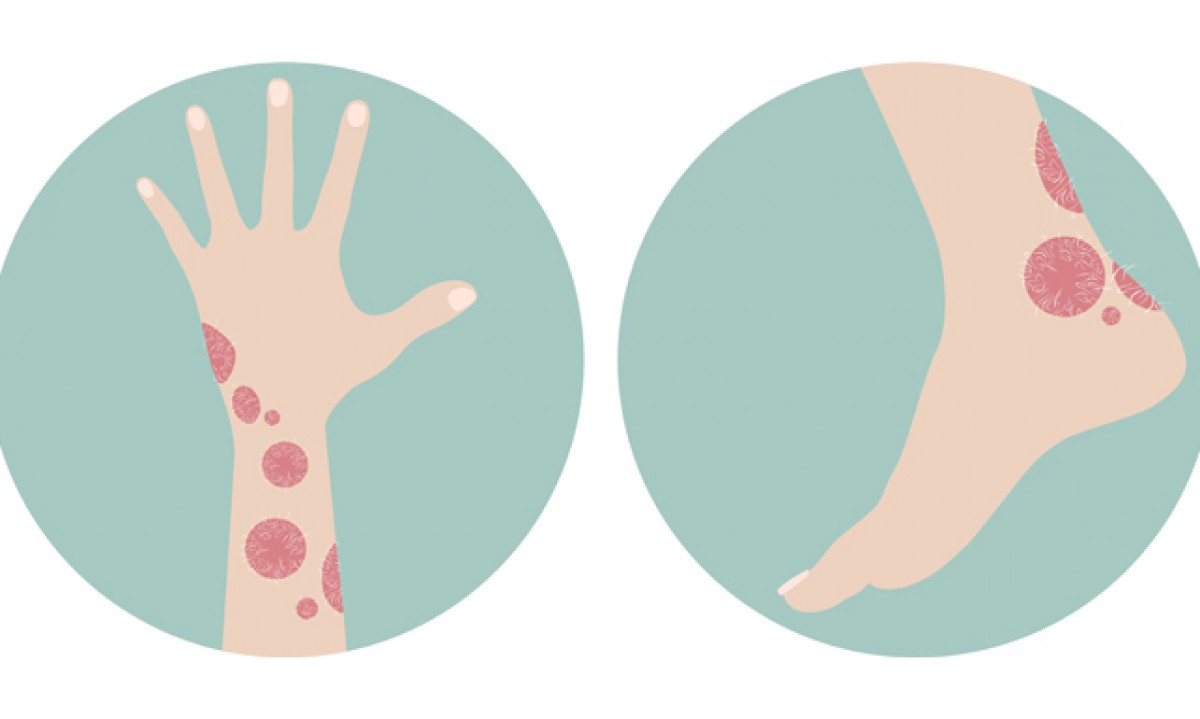 Psoriasis, una enfermedad crónica controlada