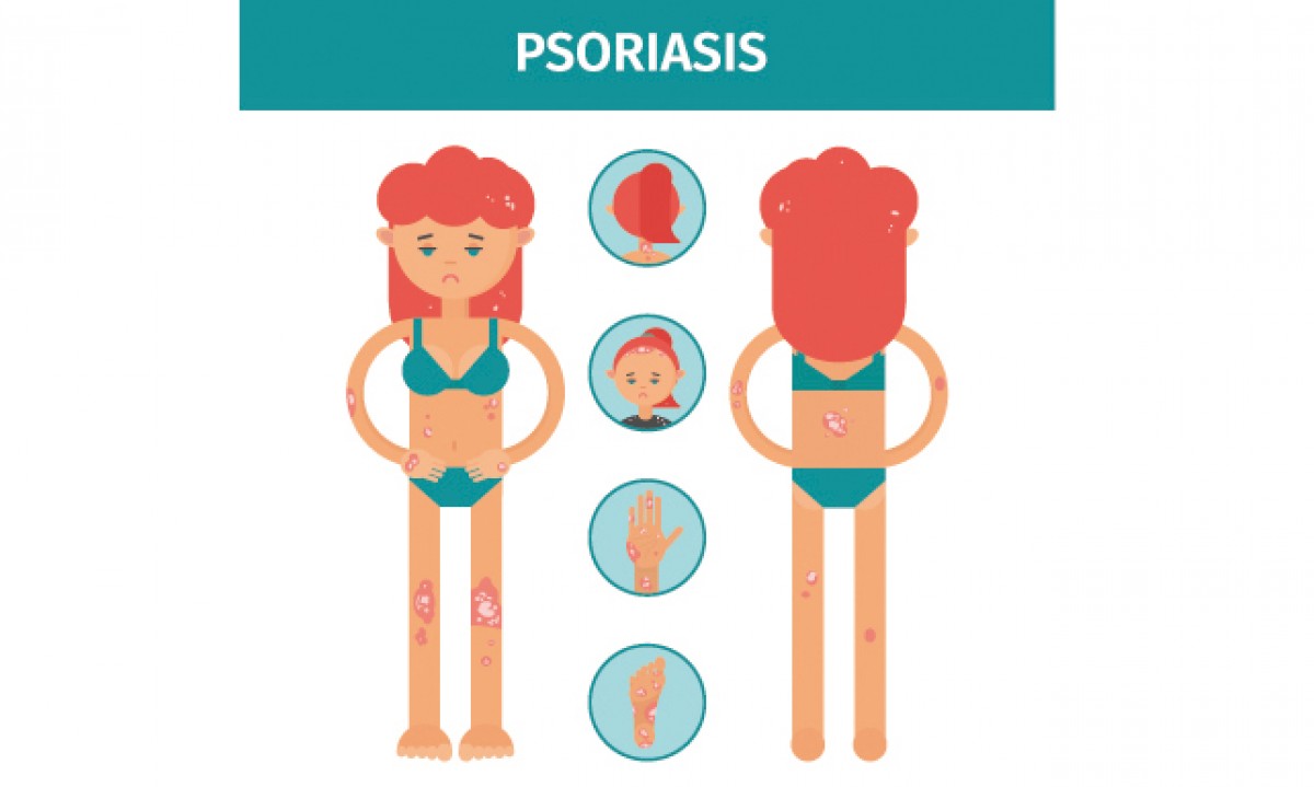 Psoriasis, una enfermedad crónica controlada